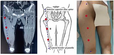 Correlation Between Body Mass Index and Anterolateral Thigh Flap Thickness: A Retrospective Study From a Single Center in China